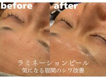 ホワイトラボ 堺東(White labo)/【40代女性 施術1回目の効果】