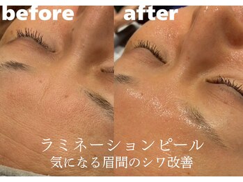 ホワイトラボ 堺東(White labo)/【40代女性 施術1回目の効果】