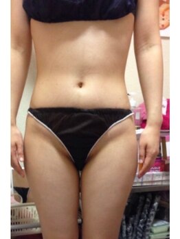 スキンケアスタジオ アコ 新宿店(Aco)/キャビテーション90分１回2/痩身