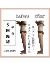 ラウレア(Laure'a)/ハイパーEX／シェイプ／ラドン