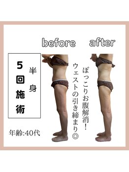 ラウレア(Laure'a)/ハイパーEX/シェイプ/ラドン