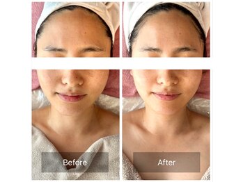 リュシータ 吹田千里丘店(LUSHEETA)/【女神肌ピーリング】(30代後半)