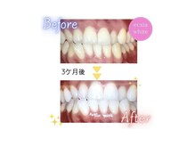 エクシアホワイトニング エミフルMASAKI店/ホワイトニングビフォーアフター