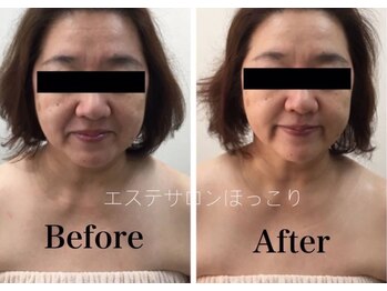 ホッコリ 段原店(HOKKORI)/効果実感No.1BBL光フェイシャル