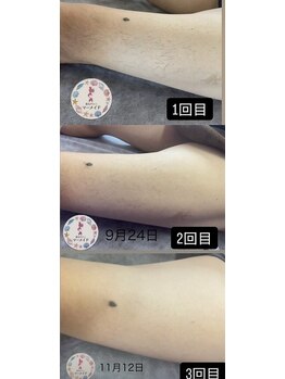 マーメイド/足もも脱毛