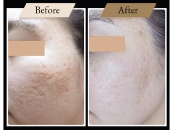 ミルトゥ(myrte)/before→after