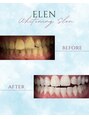 エレン 高槻店(ELEN)&nbsp;セルフホワイトニング/大阪/高槻/茨木/小顔/美白