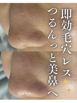 ブリリオプラス 四条烏丸店(Brillio plus)の写真/《毛穴の黒ずみ・皮脂汚れ》スッキリ洗浄♪ハイドロフェイシャル！つるんとしたお肌へ
