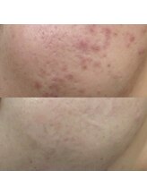 素肌新館 沼津店/before after：ニキビケア