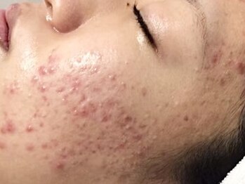ビズビズ 梅田店(bisebise)の写真/＼夏SALE¥3800★10年以上続く本気ニキビケア／無理な勧誘＆ダウンタイムなし！ハイドラ毛穴洗浄付