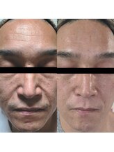 クロム(CHROME)/水光ピーリング　豊川で当店のみ