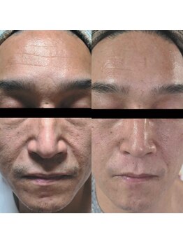 クロム(CHROME)/水光ピーリング 豊川で当店のみ