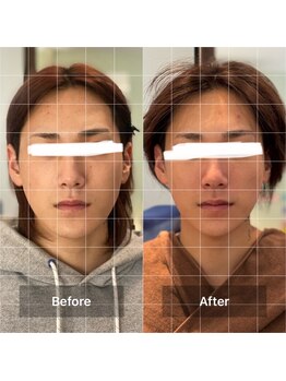 アンジェリーナ(Angelina.)/小顔美顔矯正ビフォーアフター」