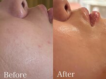 アティレ オオサカ(Attirer Osaka)/肌質改善/毛穴