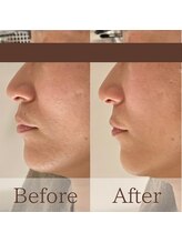 凪眠/小顔リンパフェイシャルの効果36