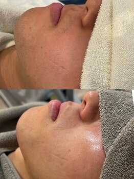 パリスヒロトン(PARIS HIROTON)/美肌脱毛【エステレベル最上級】