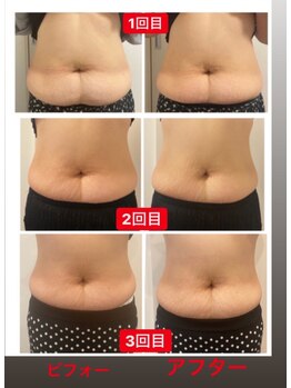 ビューティルーム ミセル(beautyroom miseru)/お腹　電磁パルス