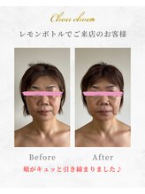 シュシュ(Chouchou)/レモンボトル1回