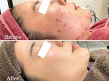 八王子ニキビ研究所/赤ニキビ・白ニキビケアも同時に