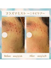 ロティス(LOTIS)/プラズマミスト～ニキビケア～