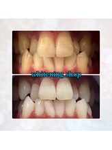 ホワイトニングショップ 奈良香芝店(Whitening shop)/歯のガタつきが気になる方