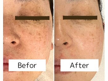 プレジール(Plaisir)/40代のシミくすみ改善