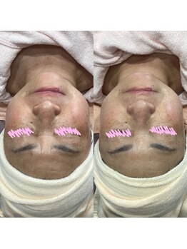 じゅえる/バルーンエステの効果