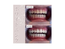 エクシアホワイトニング エミフルMASAKI店/ホワイトニングビフォーアフター
