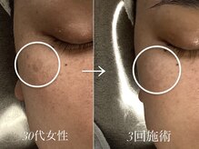 リベルテ(LIBERTE)/30代のシミケア