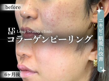 リープ(Leap)/コラーゲンピーリング