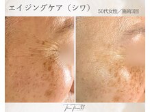 スリースリー 恵比寿(THREE THREE)/エイジングケア・しわ・たるみ