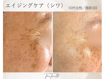 スリースリー 恵比寿(THREE THREE)/エイジングケア・しわ・たるみ