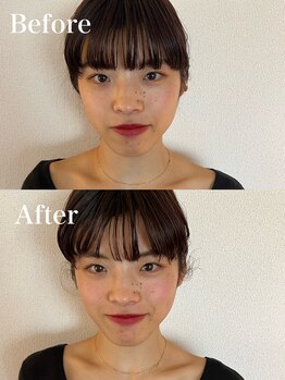 けんたろう鍼灸院/鬼美容鍼