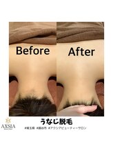 アクシア ビューティー サロン(AXSIA)/【うなじ脱毛BeforeAfter】