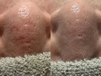 リボーン(REBORN)/徹底毛穴ケア