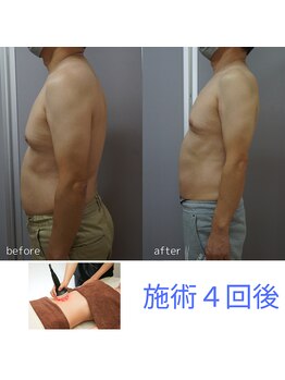 アップルミント/＜痩身＞before・after