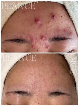 プランス 恵比寿店(PLANCE)/繰り返すおでこのニキビ