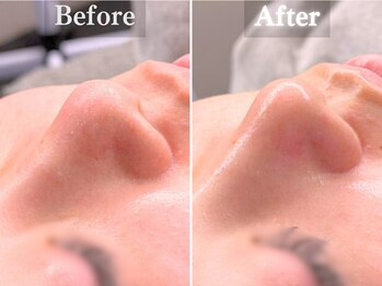 ボーンオム(Born Homme)/毛穴洗浄+美容液導入:20代女性