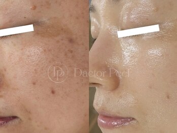 スピカ(SPICA)/ダクトピール