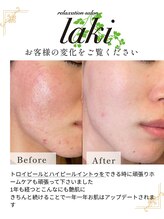 リラクゼーションサロン ラキ(laki)/トロイアルケ　スキンメイド
