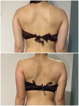 OBS/二の腕・背中/ブライダル