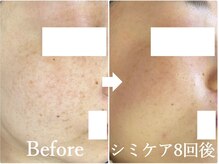 ニコ アンド キャンディー(Nico.&Candy)/本気でシミ改善したい方募集中