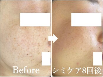 ニコ アンド キャンディー(Nico.&Candy)/本気でシミ改善したい方募集中