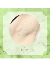 ビューティフィーサロン ベルル(Belulu)/脇脱毛 アフター