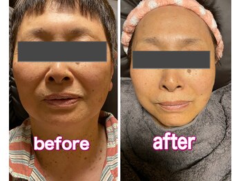 イーカナフ(E.KaNaFu)/たった1回の施術で小顔へ