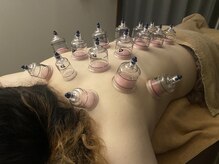 鍼灸整骨ミヤビ 札幌八軒(鍼灸整骨MIYABI)/カッピング★