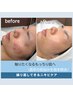 【ニキビ×毛穴】変化実感！継続でニキビを繰り返さない肌に15800⇒8800/越谷