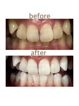 セルフホワイトニング専門店　 ホワイトニングショップ船橋2号店【ホワイトニング】/Before&After美白ホワイトニング