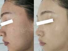 スピカ(SPICA)/ダクトピール