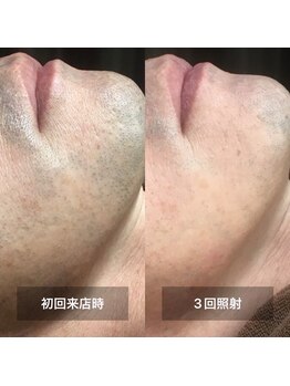 リムル(REMURU)/ひげ脱毛3回照射